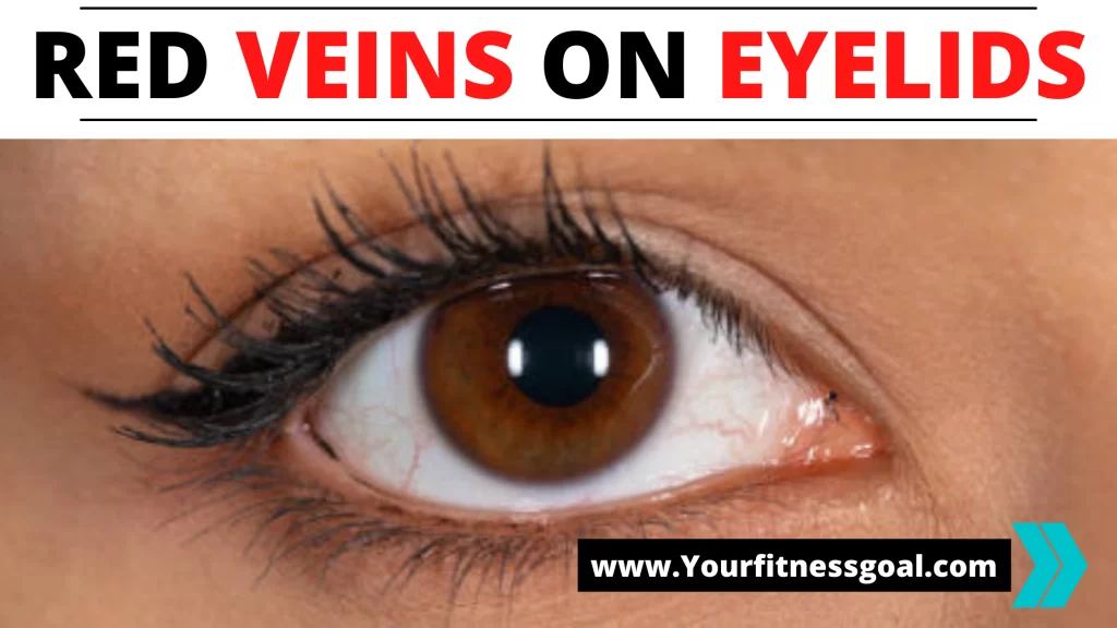 red veins on eyelids