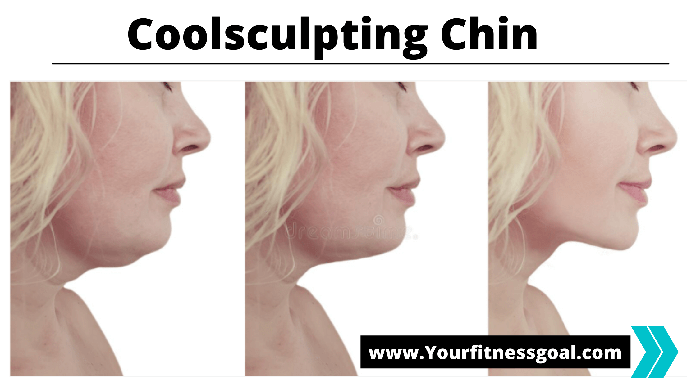 coolsculpting chin